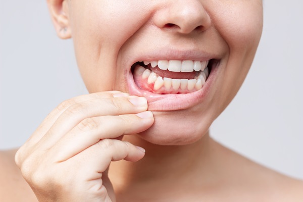 Understanding Gum Recession: Causes And Treatment Options